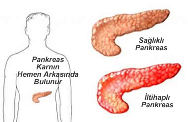 akut pankreas
