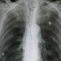 Akciğer Ödemi Nedir