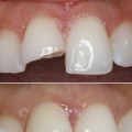 Diş Kırılması Tedavisi